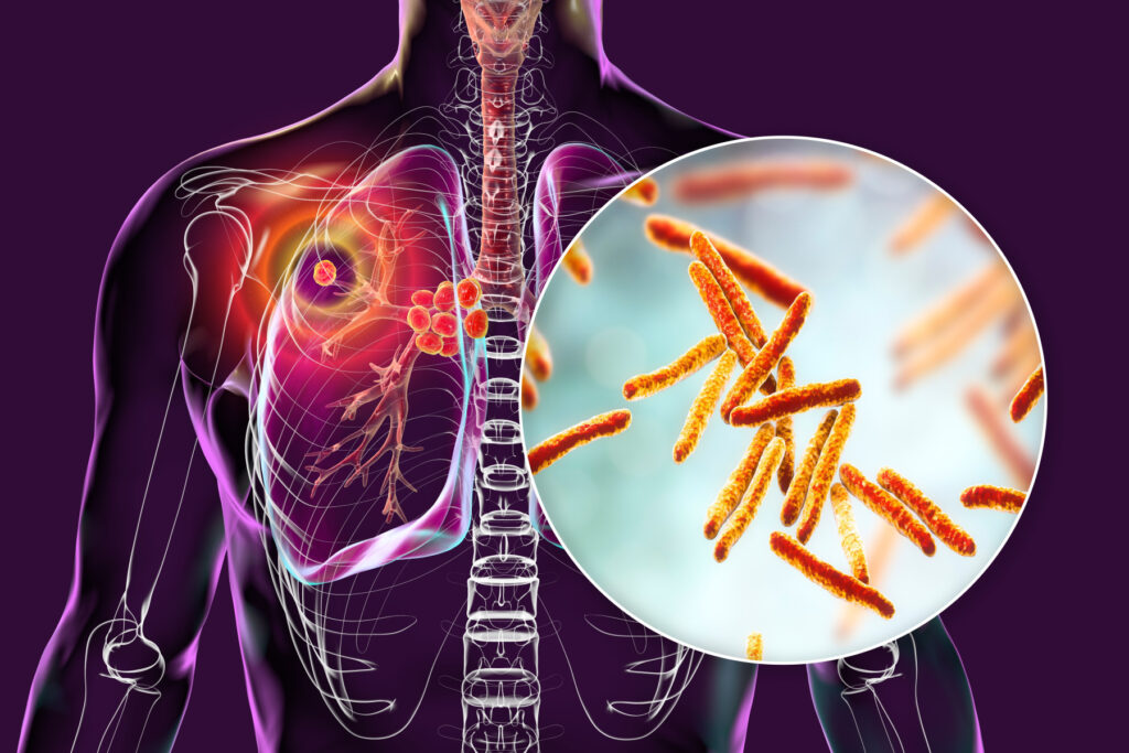TB Treatment in Delhi
